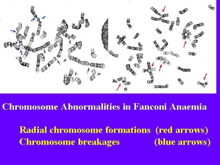 Chromosome Abnormalities in Fanconi Anaemia Radial chromosome formations (red arrows) Chromosome breakages (blue arrows)