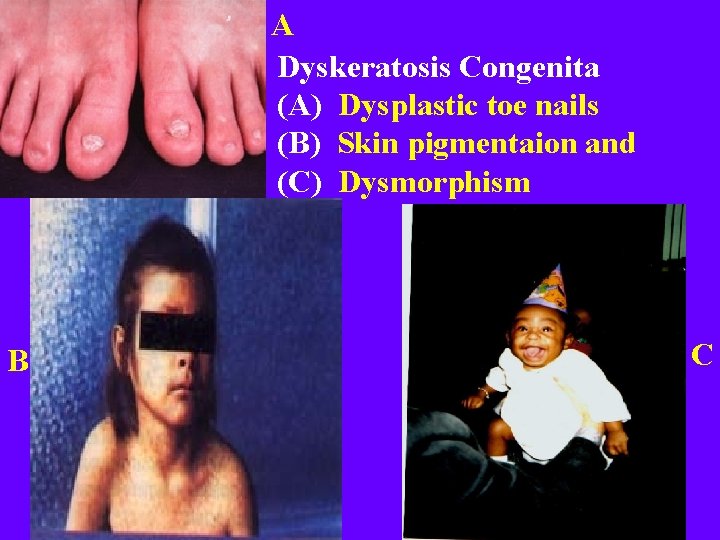 A Dyskeratosis Congenita (A) Dysplastic toe nails (B) Skin pigmentaion and (C) Dysmorphism B