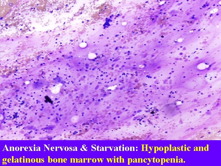 Anorexia Nervosa & Starvation: Hypoplastic and gelatinous bone marrow with pancytopenia. 