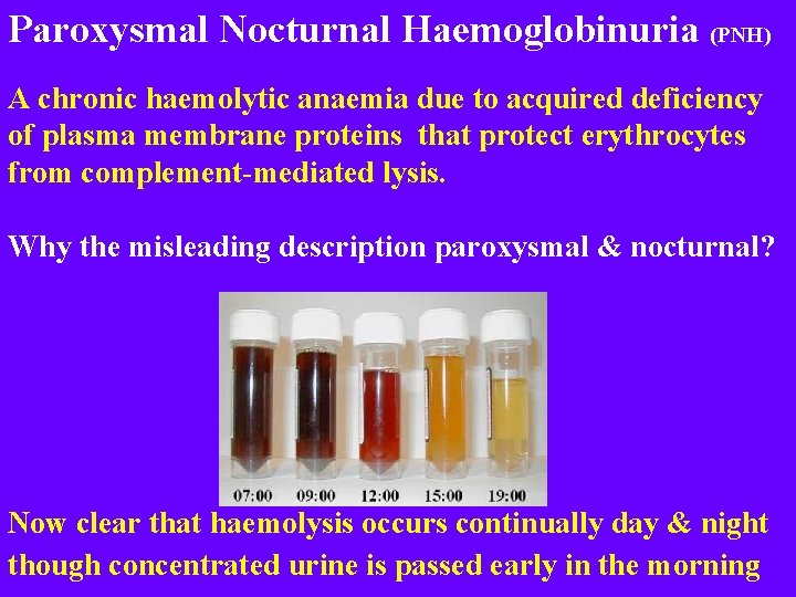 Paroxysmal Nocturnal Haemoglobinuria (PNH) A chronic haemolytic anaemia due to acquired deficiency of plasma