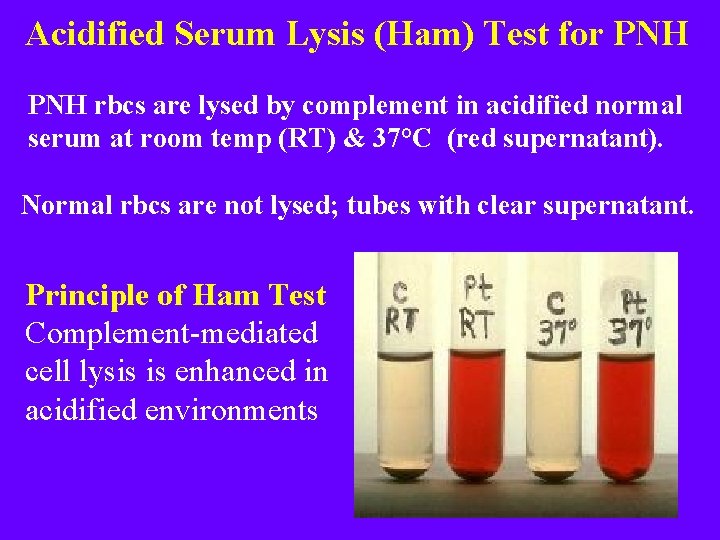 Acidified Serum Lysis (Ham) Test for PNH rbcs are lysed by complement in acidified