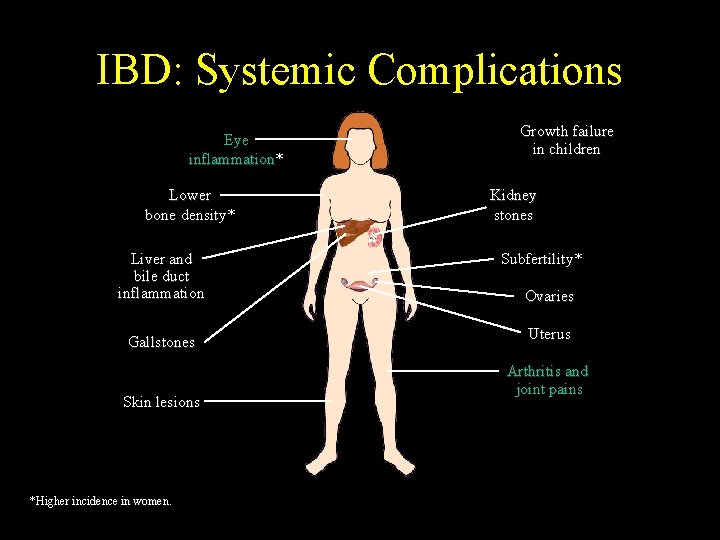 IBD: Systemic Complications Eye inflammation* Lower bone density* Liver and bile duct inflammation Gallstones