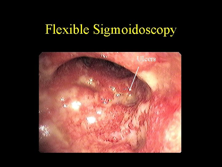 Flexible Sigmoidoscopy Ulcers 