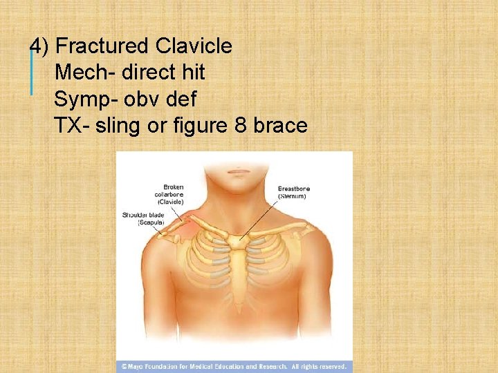 4) Fractured Clavicle Mech- direct hit Symp- obv def TX- sling or figure 8