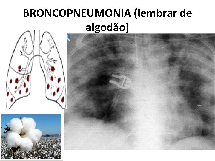 BRONCOPNEUMONIA (lembrar de algodão) 