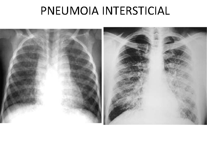 PNEUMOIA INTERSTICIAL 
