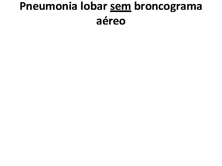 Pneumonia lobar sem broncograma aéreo 