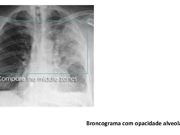 Broncograma com opacidade alveola 