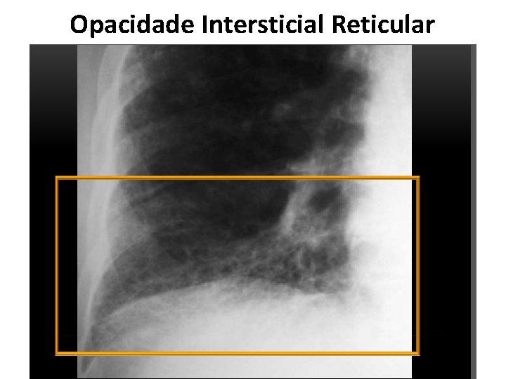 Opacidade Intersticial Reticular 