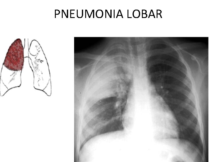 PNEUMONIA LOBAR 