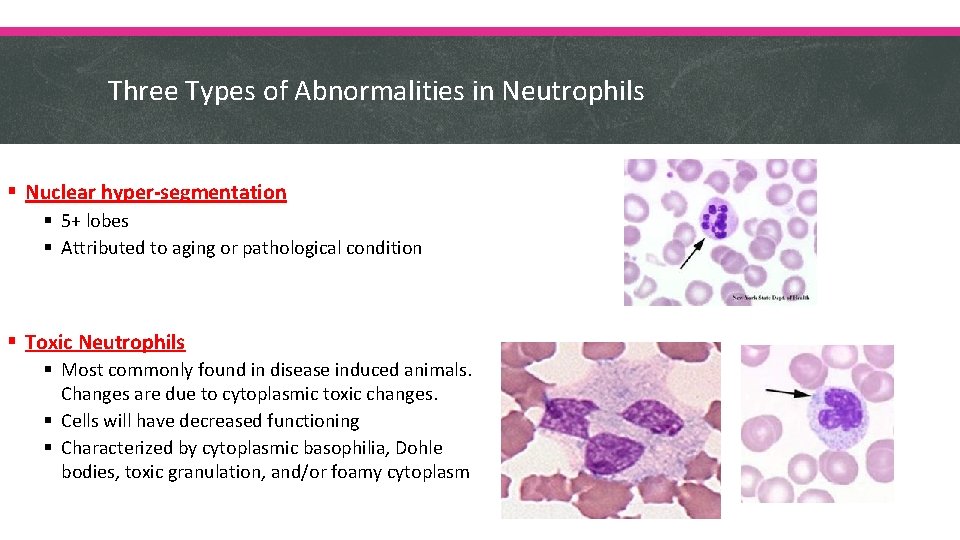 Three Types of Abnormalities in Neutrophils § Nuclear hyper-segmentation § 5+ lobes § Attributed