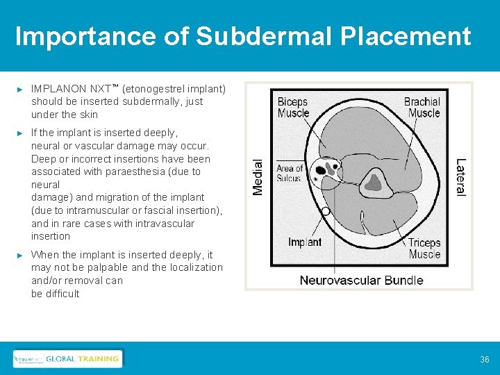 Importance of Subdermal Placement ► IMPLANON NXT™ (etonogestrel implant) should be inserted subdermally, just