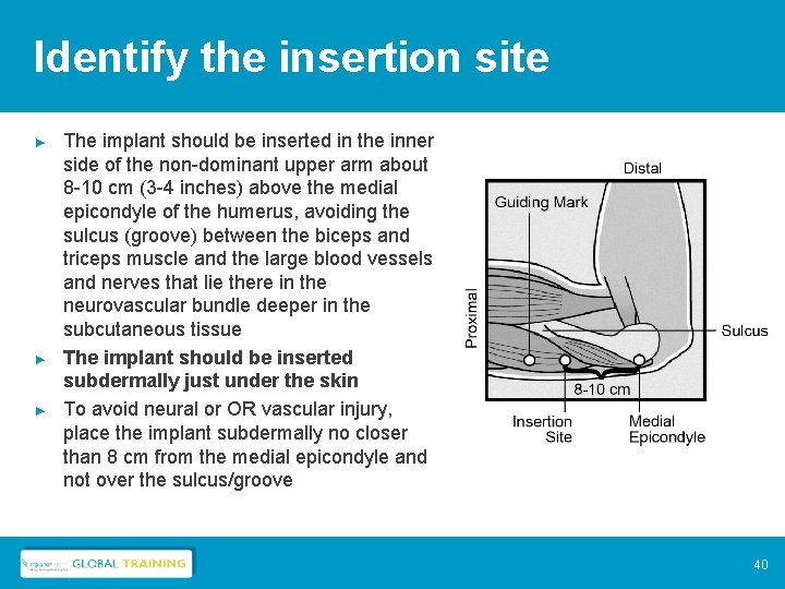 Identify the insertion site ► ► ► The implant should be inserted in the