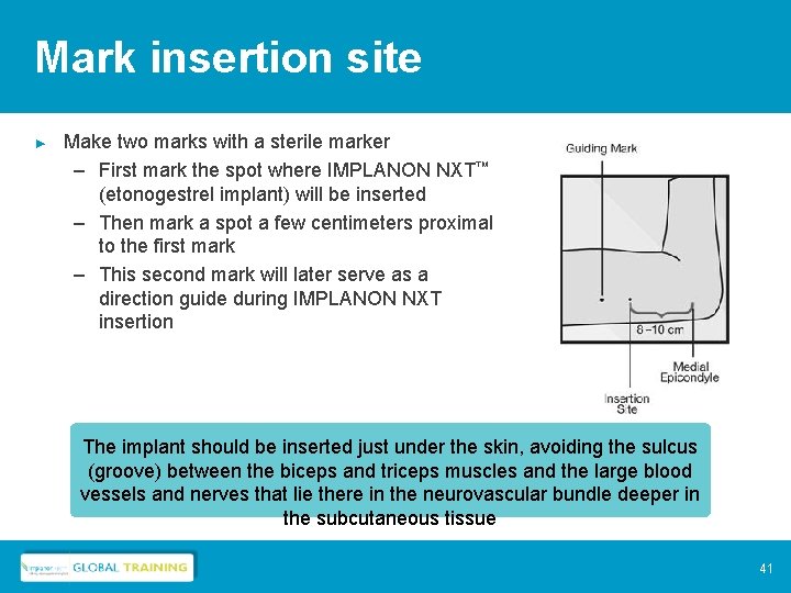 Mark insertion site ► Make two marks with a sterile marker – First mark