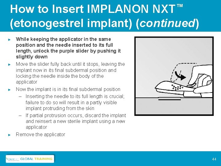 How to Insert IMPLANON NXT™ (etonogestrel implant) (continued) ► While keeping the applicator in