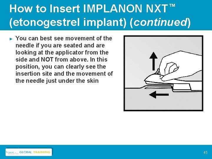 How to Insert IMPLANON NXT™ (etonogestrel implant) (continued) ► You can best see movement