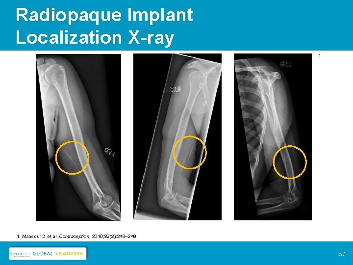Radiopaque Implant Localization X-ray 1 1. Mansour D et al. Contraception. 2010; 82(3): 243–