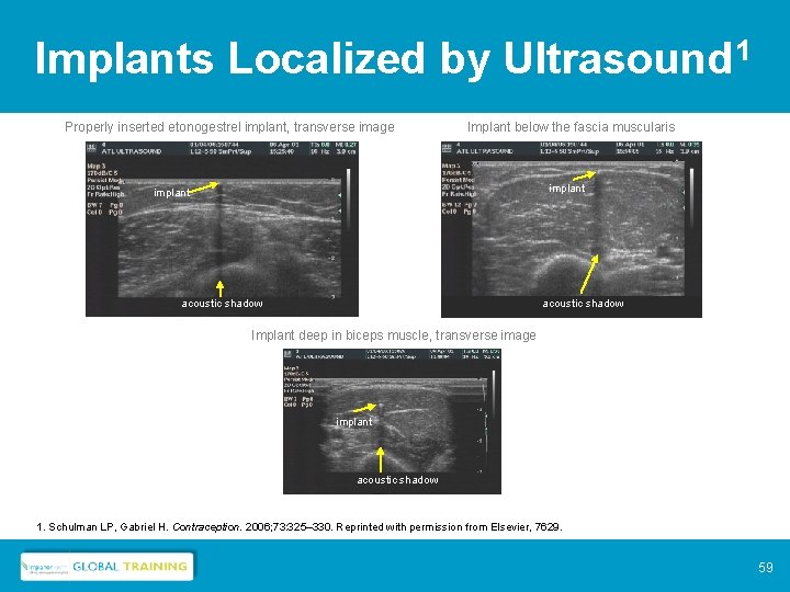 Implants Localized by Ultrasound 1 Properly inserted etonogestrel implant, transverse image Implant below the