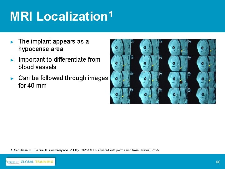 MRI Localization 1 ► The implant appears as a hypodense area ► Important to