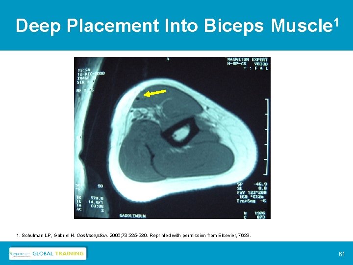 Deep Placement Into Biceps Muscle 1 1. Schulman LP, Gabriel H. Contraception. 2006; 73: