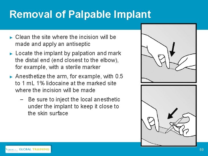 Removal of Palpable Implant ► Clean the site where the incision will be made