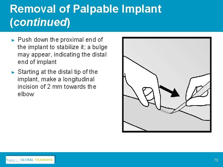 Removal of Palpable Implant (continued) ► Push down the proximal end of the implant