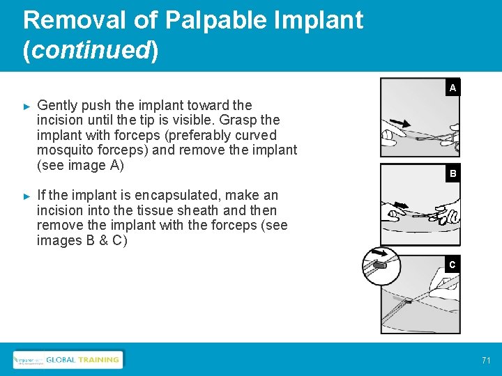 Removal of Palpable Implant (continued) A ► ► Gently push the implant toward the