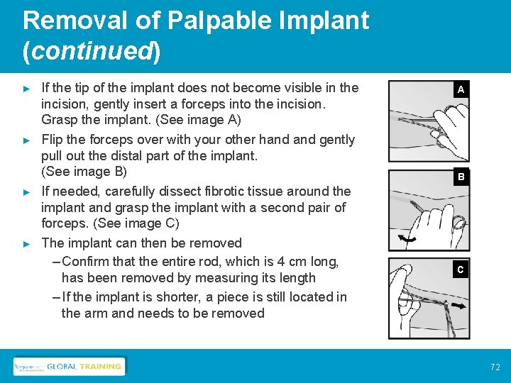 Removal of Palpable Implant (continued) ► ► If the tip of the implant does