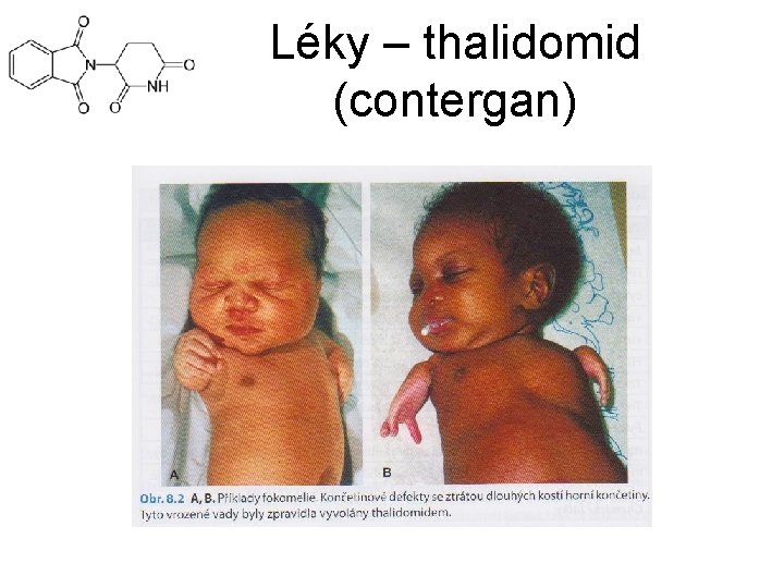Léky – thalidomid (contergan) 