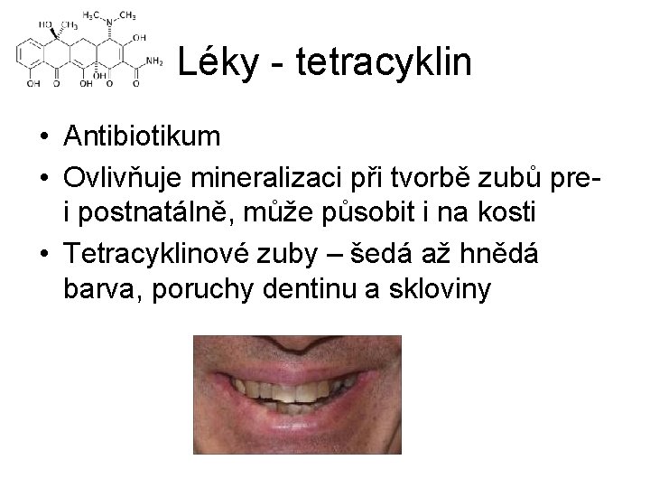 Léky - tetracyklin • Antibiotikum • Ovlivňuje mineralizaci při tvorbě zubů prei postnatálně, může