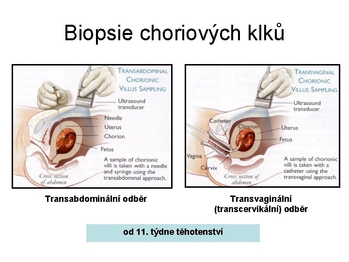 Biopsie choriových klků Transabdominální odběr Transvaginální (transcervikální) odběr od 11. týdne těhotenství 