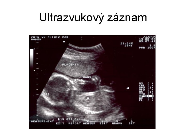 Ultrazvukový záznam 