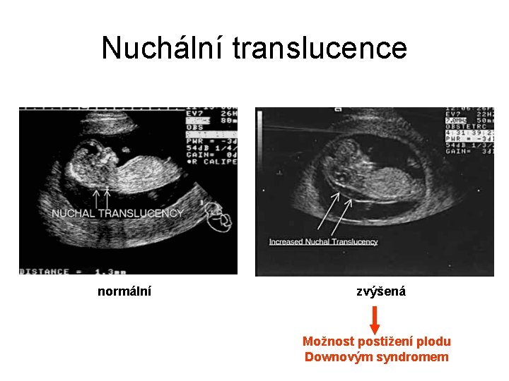 Nuchální translucence normální zvýšená Možnost postižení plodu Downovým syndromem 