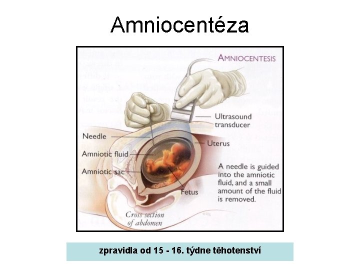Amniocentéza zpravidla od 15 - 16. týdne těhotenství 