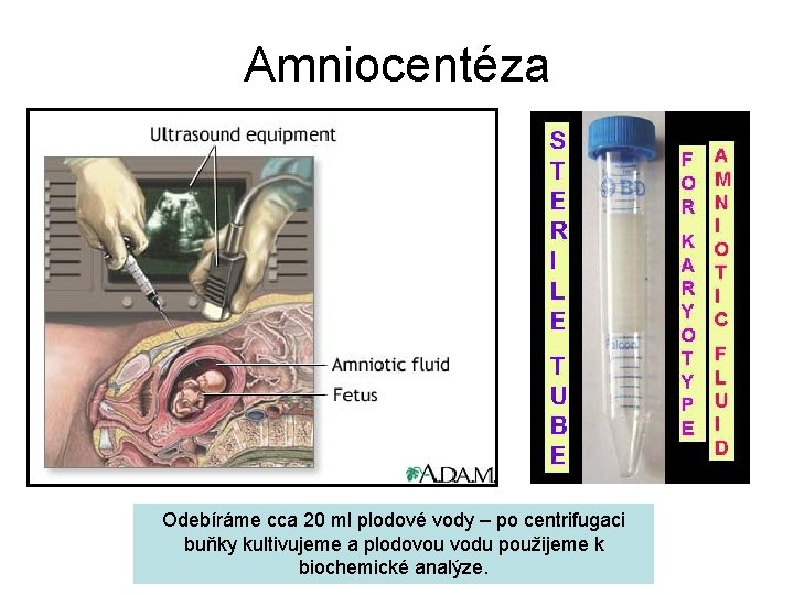 Amniocentéza Odebíráme cca 20 ml plodové vody – po centrifugaci buňky kultivujeme a plodovou