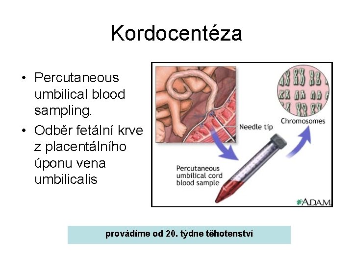 Kordocentéza • Percutaneous umbilical blood sampling. • Odběr fetální krve z placentálního úponu vena