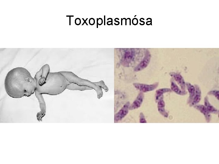 Toxoplasmósa 