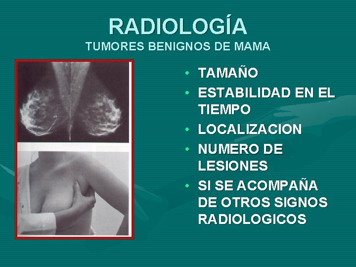 RADIOLOGÍA TUMORES BENIGNOS DE MAMA • TAMAÑO • ESTABILIDAD EN EL TIEMPO • LOCALIZACION