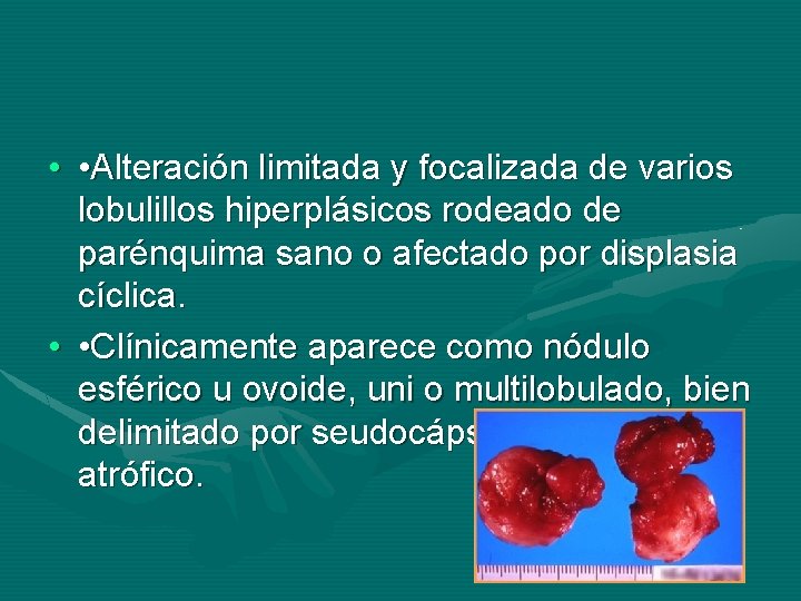  • • Alteración limitada y focalizada de varios lobulillos hiperplásicos rodeado de parénquima