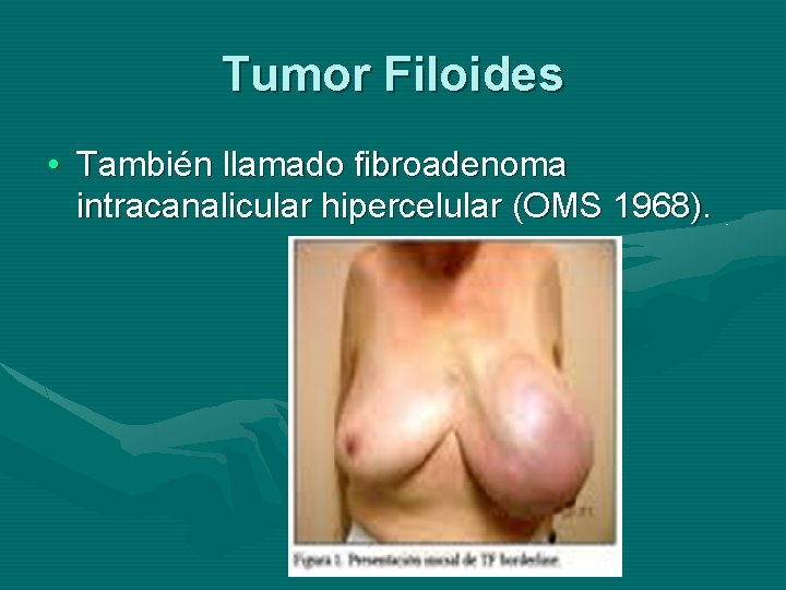 Tumor Filoides • También llamado fibroadenoma intracanalicular hipercelular (OMS 1968). 