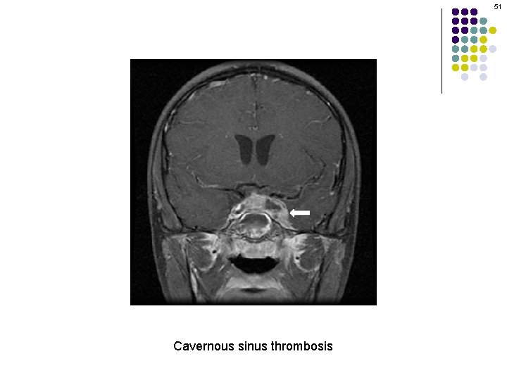 51 Cavernous sinus thrombosis 