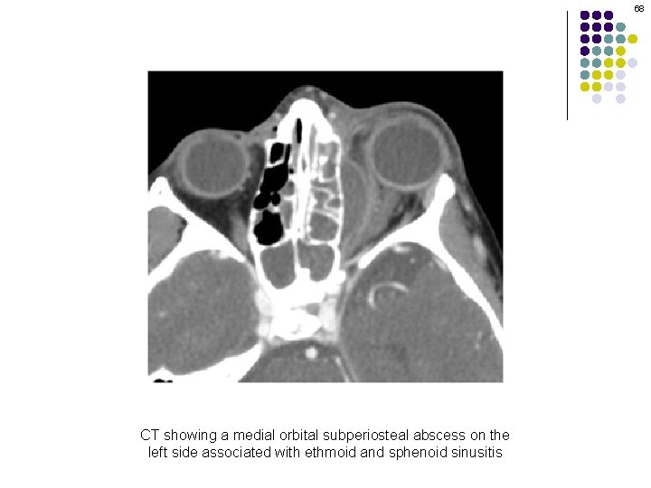 68 CT showing a medial orbital subperiosteal abscess on the left side associated with