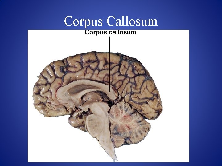Corpus Callosum 