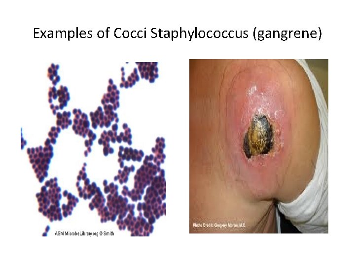Examples of Cocci Staphylococcus (gangrene) 