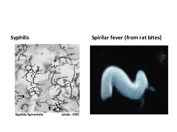 Syphilis Spirilar fever (from rat bites) 