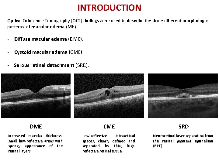 INTRODUCTION Optical Coherence Tomography (OCT) findings were used to describe three different morphologic patterns