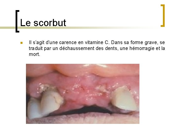 Le scorbut n Il s’agit d’une carence en vitamine C. Dans sa forme grave,