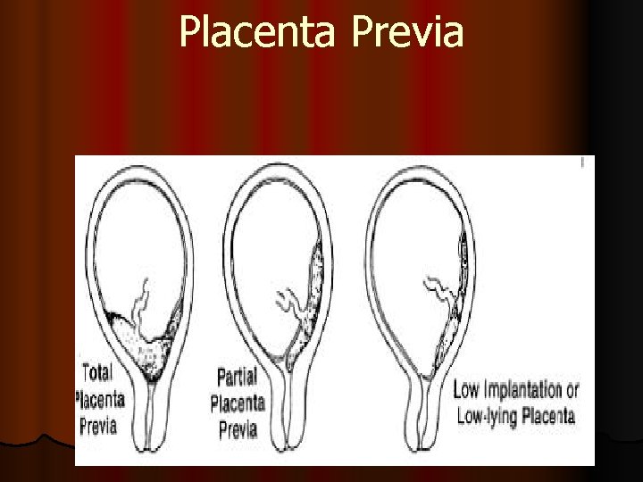 Placenta Previa 