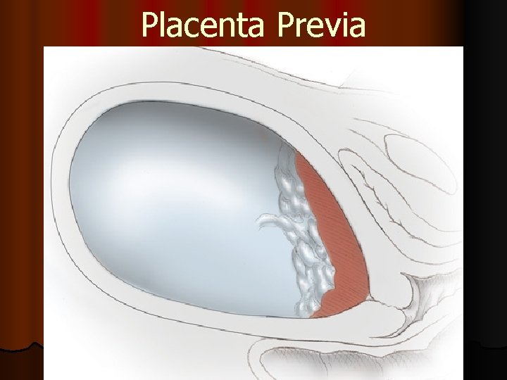 Placenta Previa 