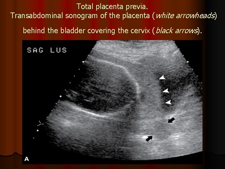 Total placenta previa. Transabdominal sonogram of the placenta (white arrowheads) behind the bladder covering